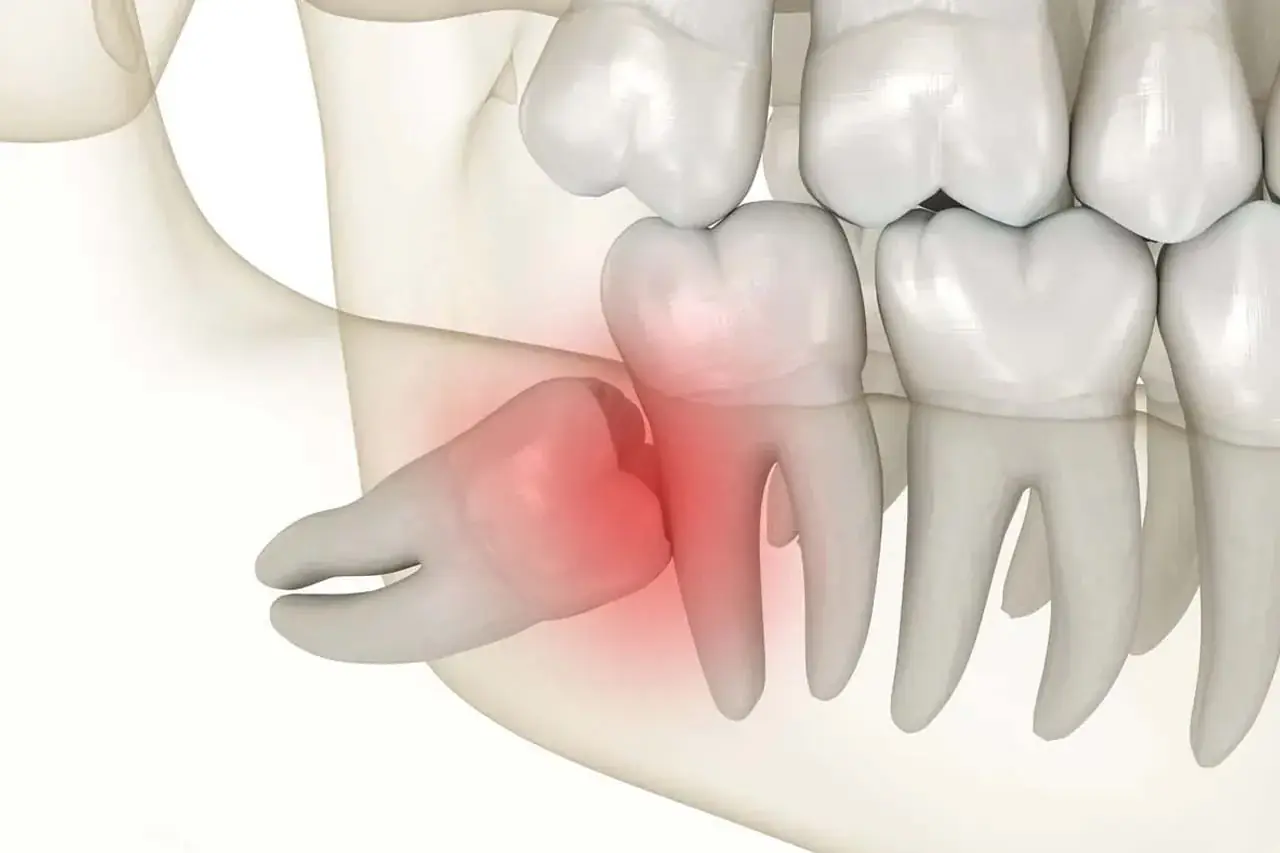 Impacted Wisdom Teeth
